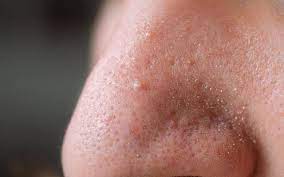 How to Remove The Problem of Male Blackheads, Know पुरुष ब्लैकहेड्स की समस्या को ऐसे करें दूर,जानें