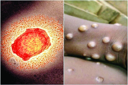 Monkeypox : प्रदेश में मंकी पॉक्स को लेकर स्वास्थ्य विभाग अलर्ट