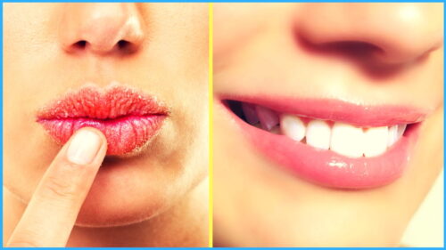 Home Remedies For Craked Lips: फटे होठों को मुलायम और खूबसूरत बनाने के लिए अपनाएं ये घरेलू नुस्खे