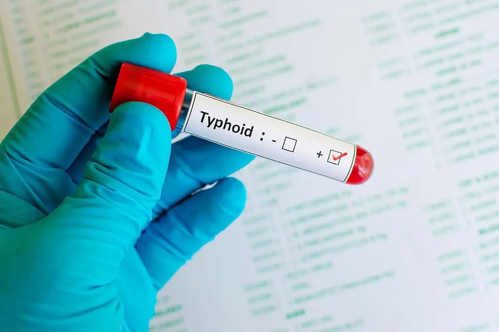 Quick Recovery From Typhoid : टाइफाइड से जल्दी रिकवरी के लिए फॉलो करें ये आसान उपाय 