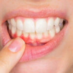 Gum Pain Home Remedies