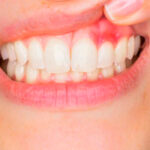 Home Remedies for Gums