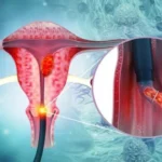 cervical cancer